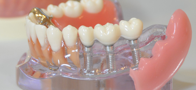 足立区の歯医者、日比谷歯科医院の信頼のインプラント治療