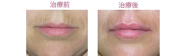 口の周囲への注入